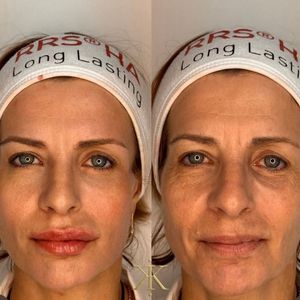 אסתטיקת פנים | כץ קליניק katz clinic