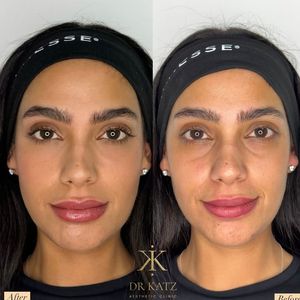 אסתטיקת פנים | כץ קליניק katz clinic