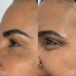 אסתטיקת פנים | כץ קליניק katz clinic