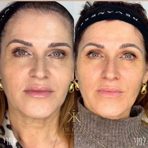 אסתטיקת פנים | כץ קליניק katz clinic