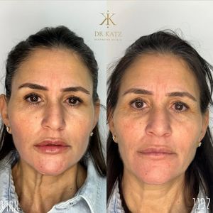 אסתטיקת פנים | כץ קליניק katz clinic