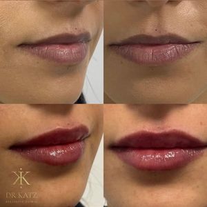 אסתטיקת פנים | כץ קליניק katz clinic