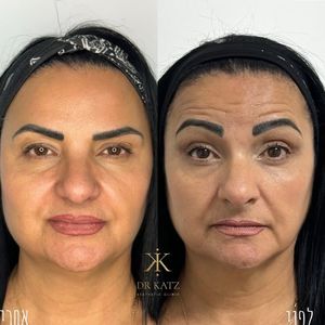 אסתטיקת פנים | כץ קליניק katz clinic