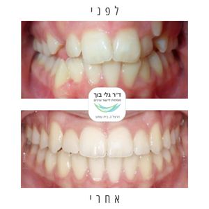 יישור שיניים - אורתודונטיה - מומחה | ד"ר גלי בוך