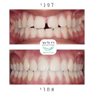 יישור שיניים - אורתודונטיה - מומחה | ד"ר גלי בוך