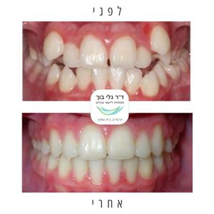 יישור שיניים - אורתודונטיה - מומחה | ד"ר גלי בוך