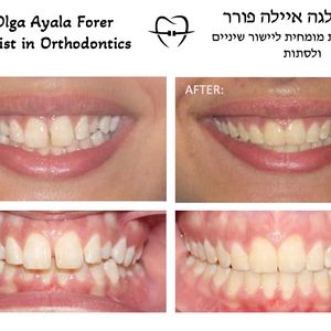 יישור שיניים - אורתודונטיה - מומחה | ד"ר אולגה איילה פורר