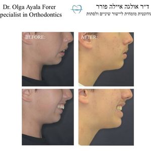 יישור שיניים - אורתודונטיה - מומחה | ד"ר אולגה איילה פורר