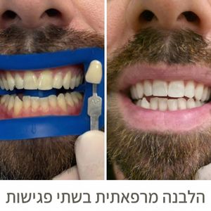 הלבנת שיניים