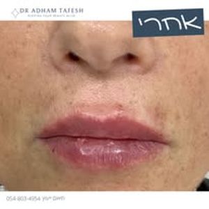 רפואה אסתטית | ד"ר טאפש אדהם Dr. Adham Tafesh