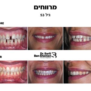 יישור שיניים - אורתודונטיה - מומחה | ד"ר שרית בן שמן