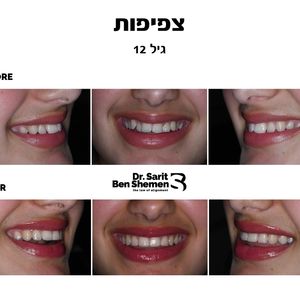 יישור שיניים - אורתודונטיה - מומחה | ד"ר שרית בן שמן