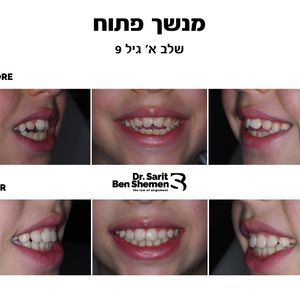 יישור שיניים - אורתודונטיה - מומחה | ד"ר שרית בן שמן