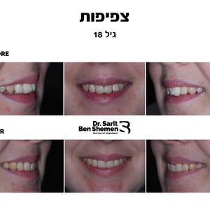יישור שיניים - אורתודונטיה - מומחה | ד"ר שרית בן שמן