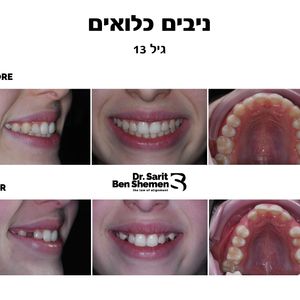 יישור שיניים - אורתודונטיה - מומחה | ד"ר שרית בן שמן