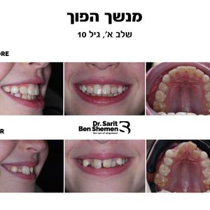 יישור שיניים - אורתודונטיה - מומחה | ד"ר שרית בן שמן
