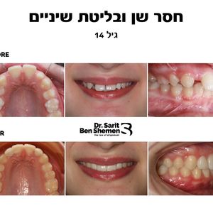 יישור שיניים - אורתודונטיה - מומחה | ד"ר שרית בן שמן