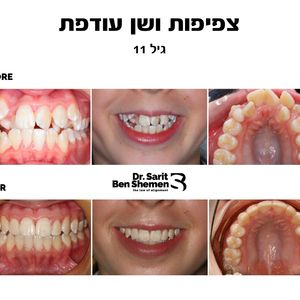 יישור שיניים - אורתודונטיה - מומחה | ד"ר שרית בן שמן