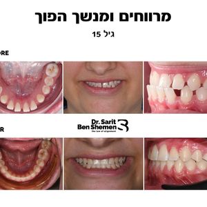 יישור שיניים - אורתודונטיה - מומחה | ד"ר שרית בן שמן