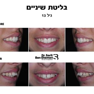 יישור שיניים - אורתודונטיה - מומחה | ד"ר שרית בן שמן
