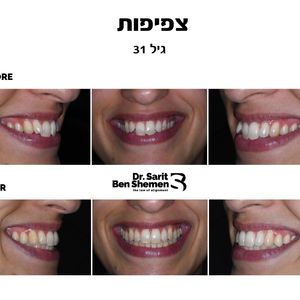 יישור שיניים - אורתודונטיה - מומחה | ד"ר שרית בן שמן