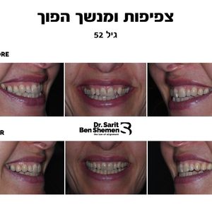 יישור שיניים - אורתודונטיה - מומחה | ד"ר שרית בן שמן