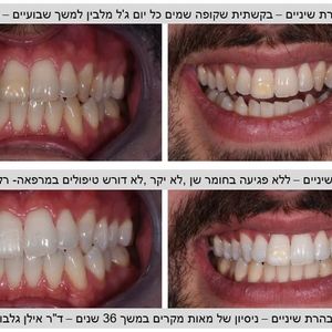 רפואת שיניים - שיקום הפה - מומחה | ד"ר אילן גלבוע