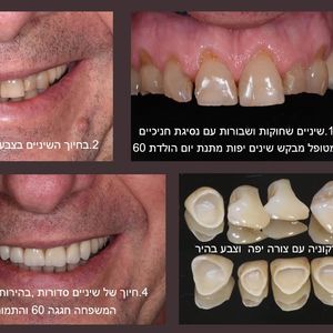 רפואת שיניים - שיקום הפה - מומחה | ד"ר אילן גלבוע