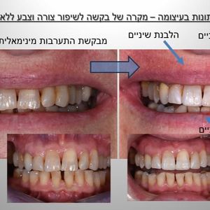 רפואת שיניים - שיקום הפה - מומחה | ד"ר אילן גלבוע