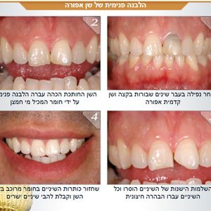 רפואת שיניים - שיקום הפה - מומחה | ד"ר אילן גלבוע