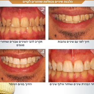 רפואת שיניים - שיקום הפה - מומחה | ד"ר אילן גלבוע