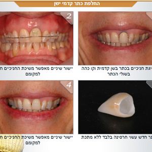 רפואת שיניים - שיקום הפה - מומחה | ד"ר אילן גלבוע