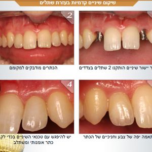 רפואת שיניים - שיקום הפה - מומחה | ד"ר אילן גלבוע