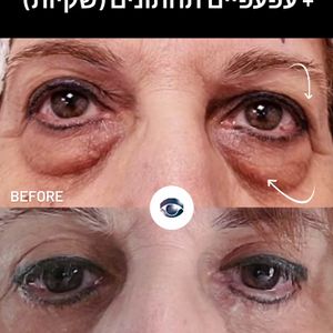 פלסטיקה של העין והארובה | ד"ר חררדו מורבניק